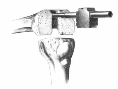 For Intramedullary, Epicondylar, or Multi-Reference 4-in-1 Femoral Instrumentation An additional cut of 2mm, 3mm, or 5mm can be made.