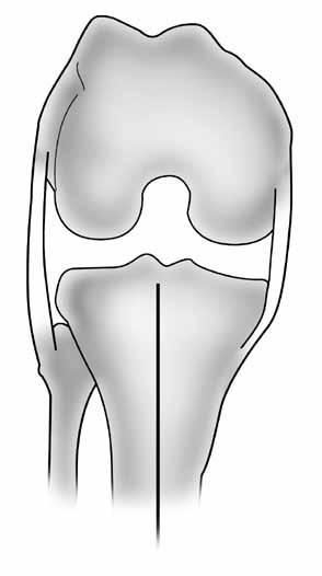 Relative to the posterior condylar line, the epicondylar line is rotated externally 0-8 (4 ± 4 ) 2.