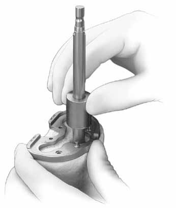 CRUCIATE RETAINING AUGMENTABLE STEP TwO FINISH THE TIBIA Select the Stemmed Tibial Sizing Plate that provides the desired tibial coverage by placing various size plates onto the resected tibial