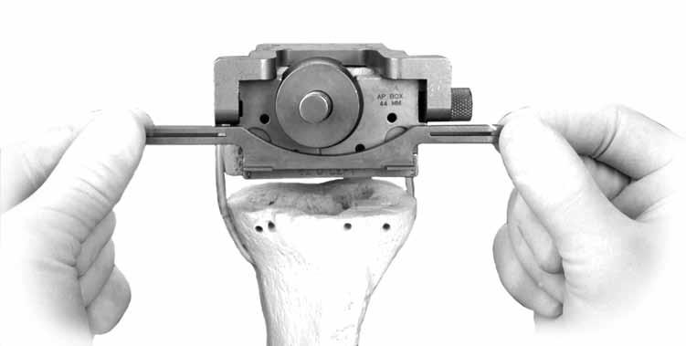 CRUCIATE RETAINING AUGMENTABLE Attach the Revision Rotational Alignment Guide to the posterior edge of the Femoral Stem Base/Cutting Block by inserting the