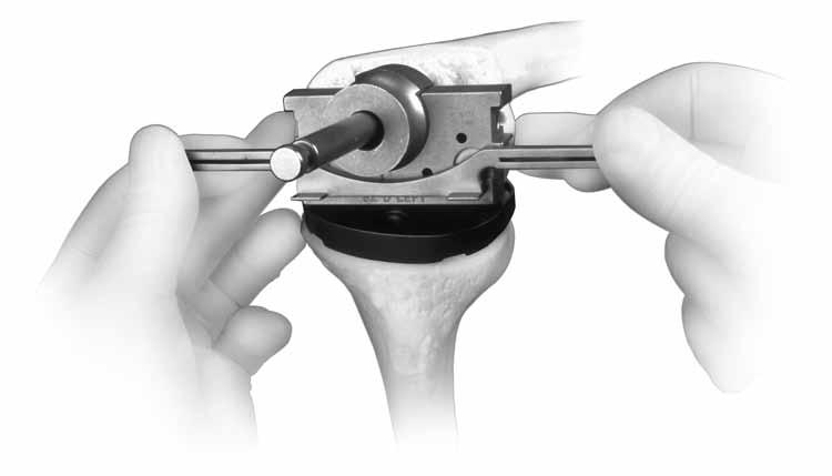 To achieve the proper external rotation of the Femoral Stem Base/Cutting Block, and the prosthesis, the handles of the alignment guide should be in line with