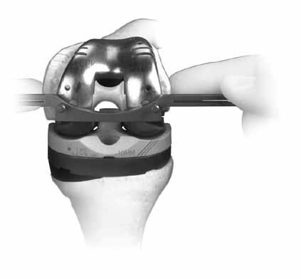 CRUCIATE RETAINING AUGMENTABLE When using a straight stem, insert the appropriate size Straight Stem Extension Provisional into the appropriate size CRA Femoral Provisional/Cutting Guide.