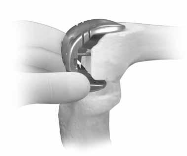 The posterior mark on the stem base of the femoral provisional must be lined up with the appropriate mark on the Offset Stem Extension Provisional.