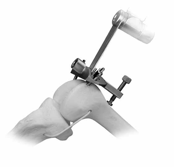 The markings on the cutting guide indicate, in millimeters, the amount of bone resection each will yield relative to the standard distal resection set by the Adjustable IM Alignment Guide and