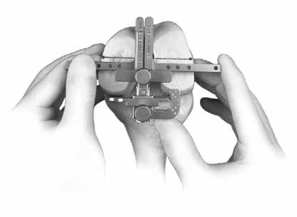 Set the rotation of the epicondylar guide parallel to the epicondylar axis. Read the angle of external rotation indicated by the Posterior Reference/Rotation Guide.