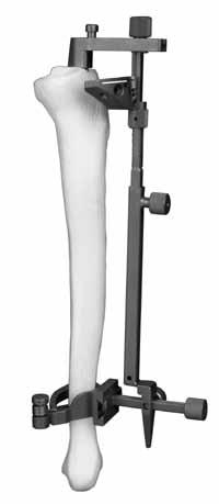 CRUCIATE RETAINING STEP TwO POSITION ALIGNMENT GUIDE To improve exposure of the tibial surface, use the Tibial Retractor to lever the tibia anteriorly.
