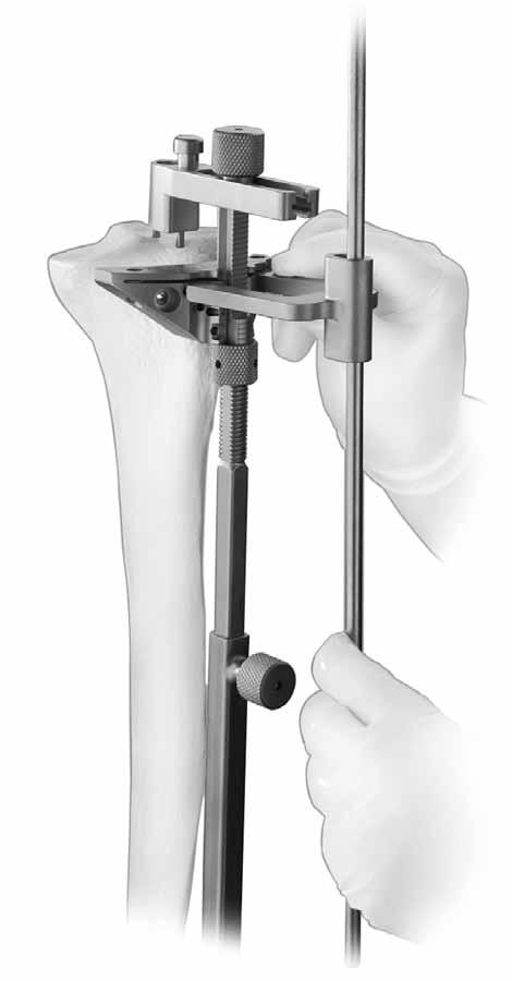 CRUCIATE RETAINING To confirm alignment, insert the Extramedullary Alignment Arch onto the Cut Guide and insert the Alignment Rod with Coupler through the arch, passing it distally toward the ankle.