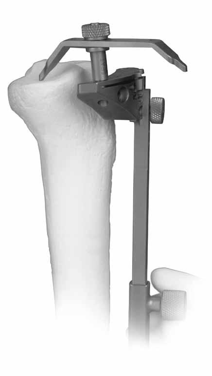 CRUCIATE RETAINING STEP THREE SET RESECTION LEVEL Each tip of the Tibial Depth Resection Stylus indicates a different depth.