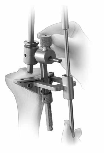 CRUCIATE RETAINING To determine varus/valgus alignment, insert the Extramedullary Alignment Arch onto the Cut Guide and insert