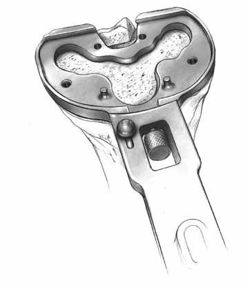 CRUCIATE RETAINING FINISH THE TIBIA The tibia can be finished prior to trial reduction if the implant position will be chosen based on anatomic landmarks.