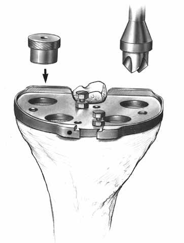 After drilling each hole, place a Tibial Holding Peg in each to aid in stability (Fig. 152). Fig.