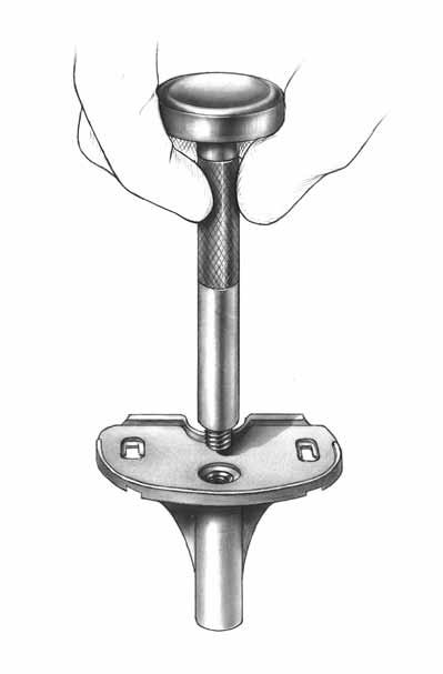 CRUCIATE RETAINING Assemble the proper size Tibial Broach to the Broach Impactor (Fig. 155). The broach can only be assembled from the front.