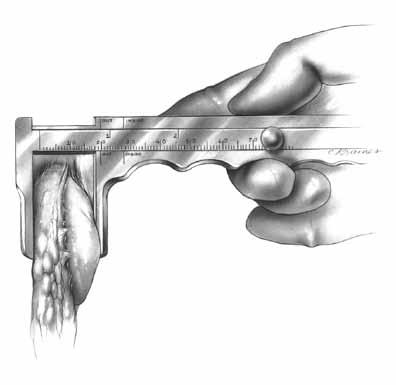 PATELLA PREPARATION PATELLA PREPARATION Fig. 160 PREPARE THE PATELLA Sharply dissect through the prepatellar bursa to expose the anterior surface of the patella.
