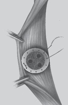 nonabsorbable suture through a hole on the posterior surface of the titanium ring (Fig. 175). Bring the needle from the anterior surface back through an adjacent hole and cut the suture (Fig. 176).