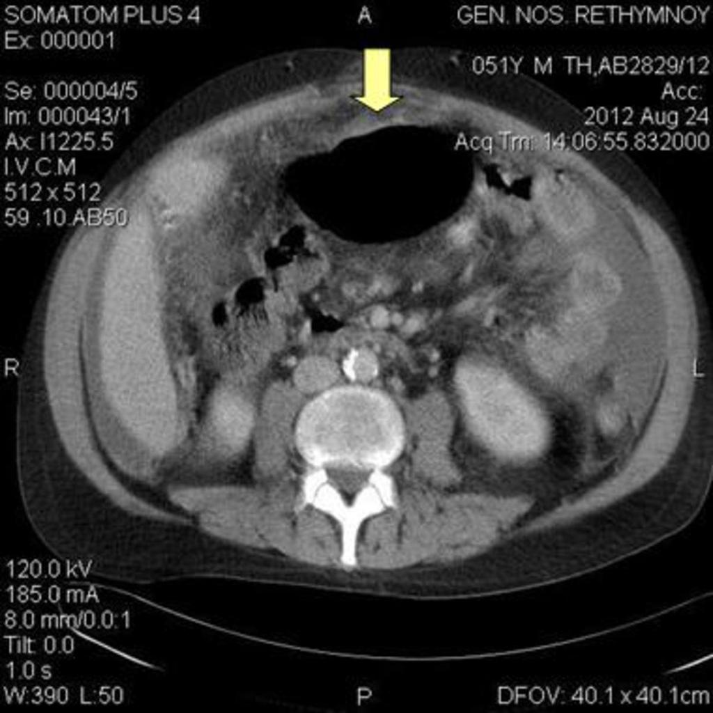 Fig. 9: Depiction of lesser sac anatomy by air - fluid collection, in a case of neglected, sealed - off, gastric perforation.