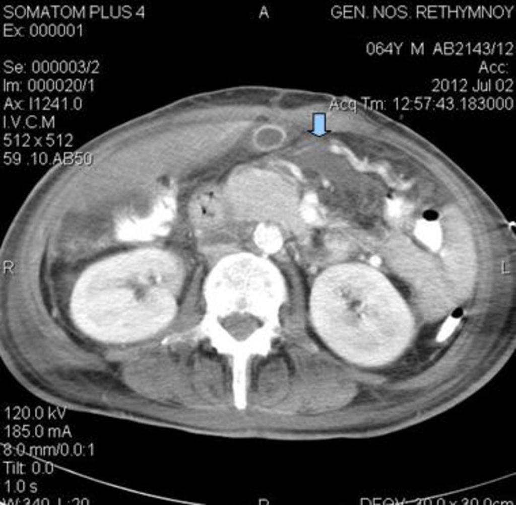 Fig. 10: Bile peritonitis in a patient with grade V liver trauma.