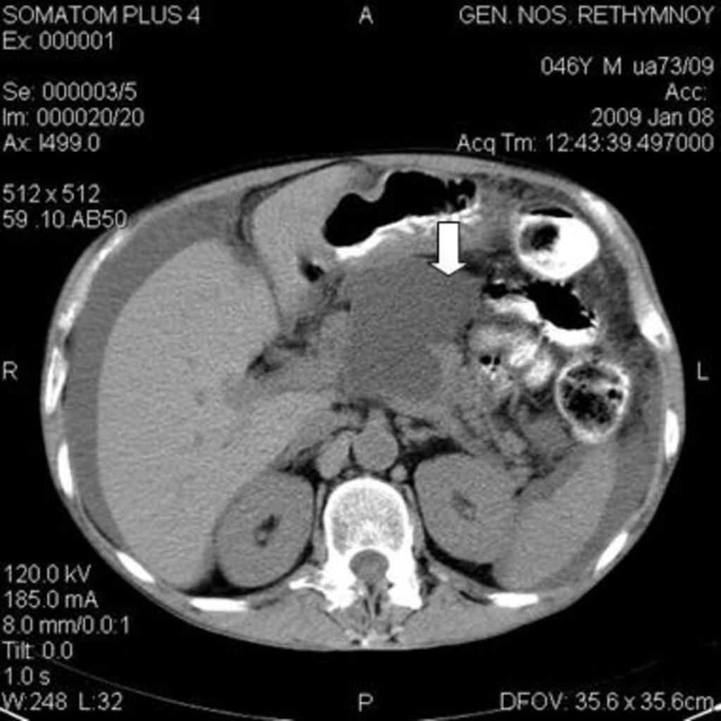 Fig. 18: Pancreatic pseudocysts (white arrows) projecting into the lesser sac in CT