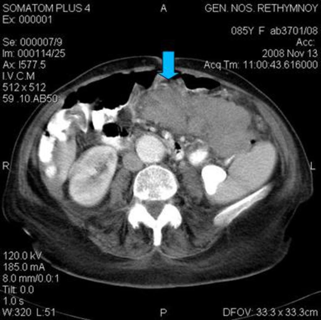 Fig. 20: Lesser sac hematoma, with mass-like configuration, in the splenic recess (white arrow) (fig.