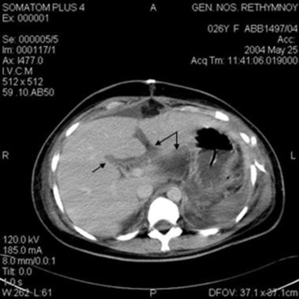 Fig. 21: Hematoma in the superior recess of lesser sac (black arrows) (fig.