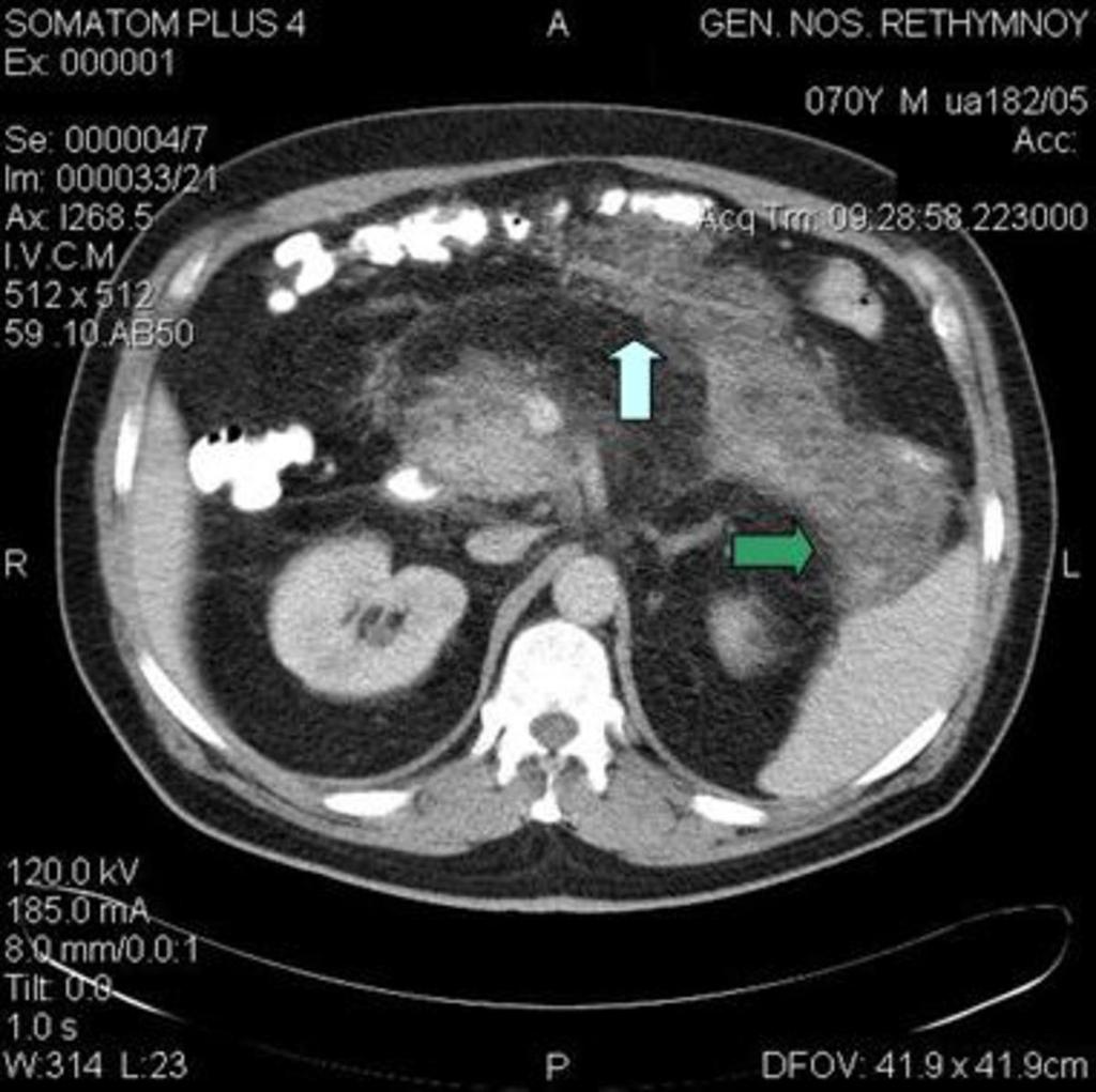 Fig. 16: Axial CT images in a patient with acute pancreatitis depict the inflammatory exudate in the lesser sac (white arrow) (fig.15).