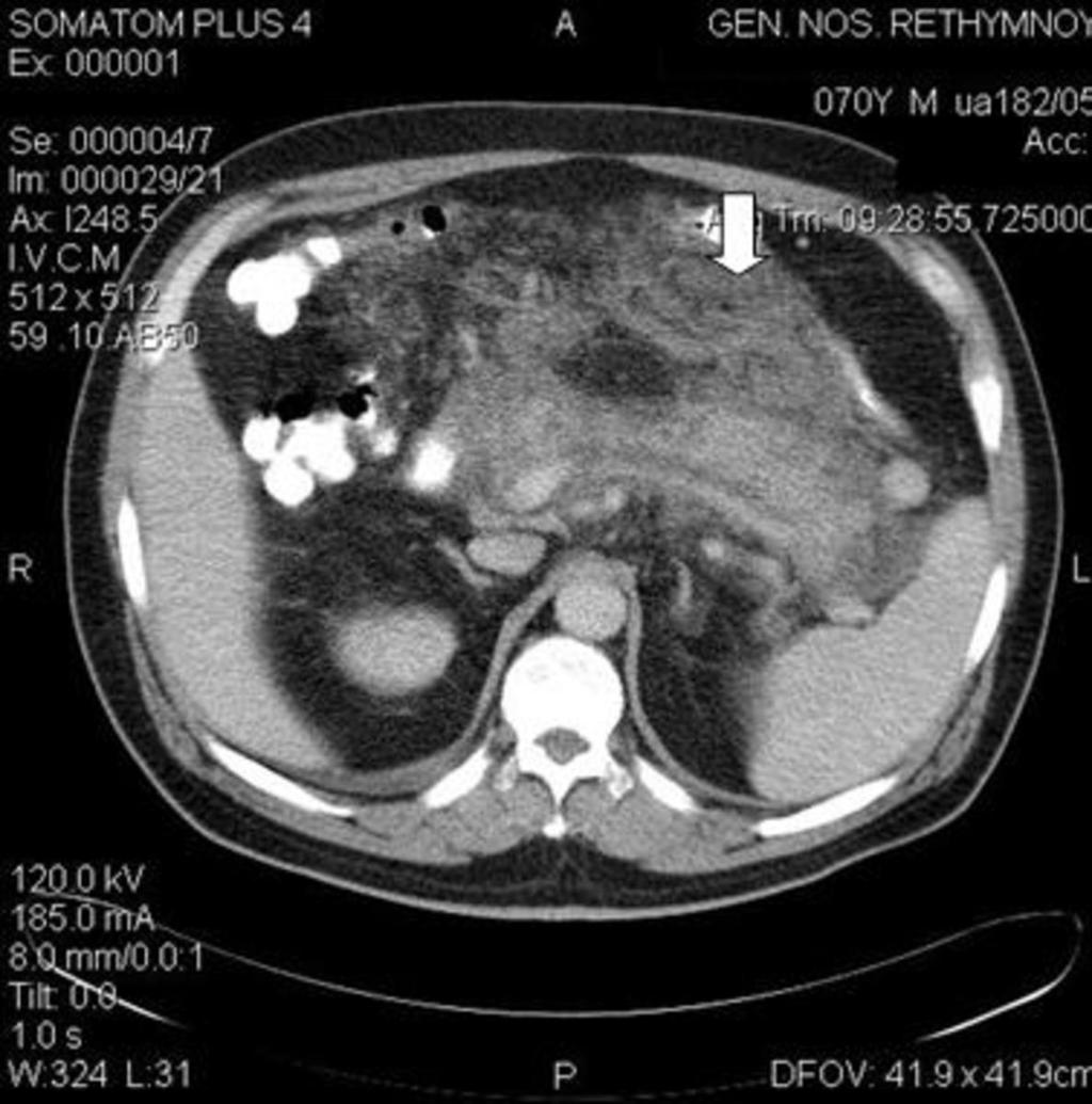 Fig. 15: Axial CT images in a patient with acute pancreatitis depict the inflammatory exudate in the lesser sac (white arrow) (fig.15).