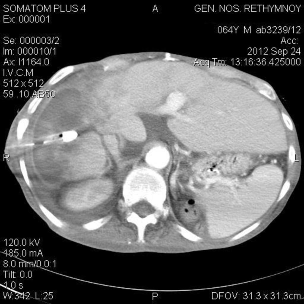 Fig. 14: Axial CT image in a patient with grade V liver trauma, complicated with intrahepatic biloma.