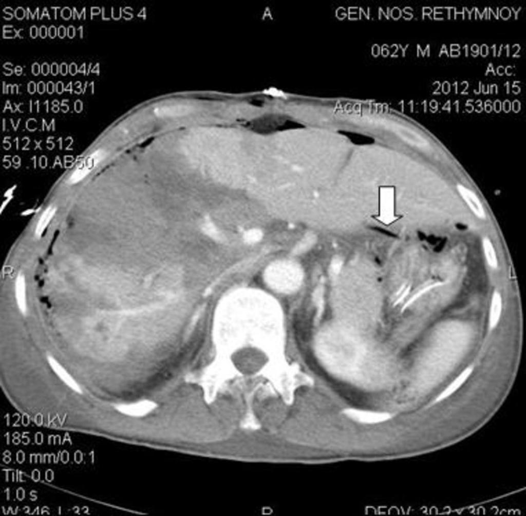 Fig. 11: Bile peritonitis in a patient with grade V liver trauma.
