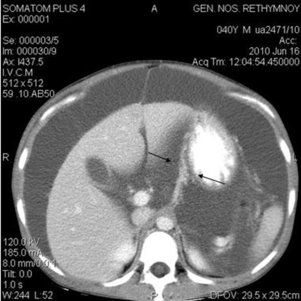 Fig. 1: CT sections in a patient with ascitic transudate.