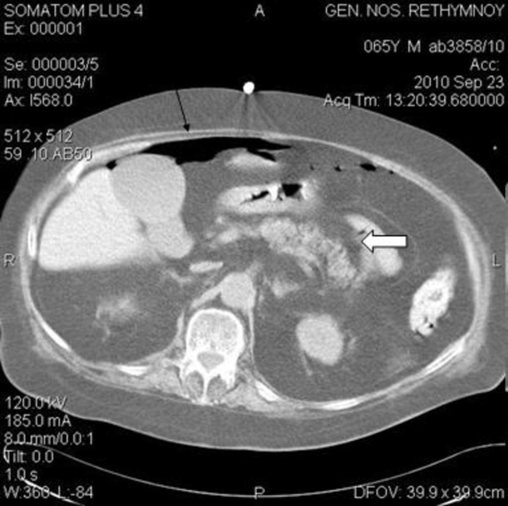 Fig. 4: Normal anatomy of the lesser sac, which consists of a superior recess (blue arrow) (fig.2,fig.3), a splenic recess (white arrow) (fig.