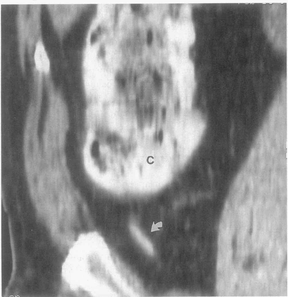 348 Rao and Others Ann. Surg. * March 1999, j Figure 3. Axial CT scan of a 24-year-old man with clumped, enlarged lymph nodes (N), a finding consistent with mesenteric adenitis. P..! _ e- -:4!