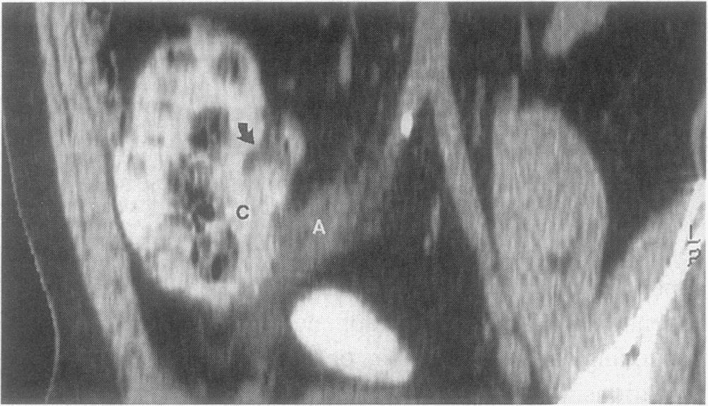 RESULTS Before Appendiceal CT Introduction who underwent primary appendec- Of the 493 patients tomy in the 38 months preceding appendiceal CT introduction, 395 (80%) had appendicitis or other