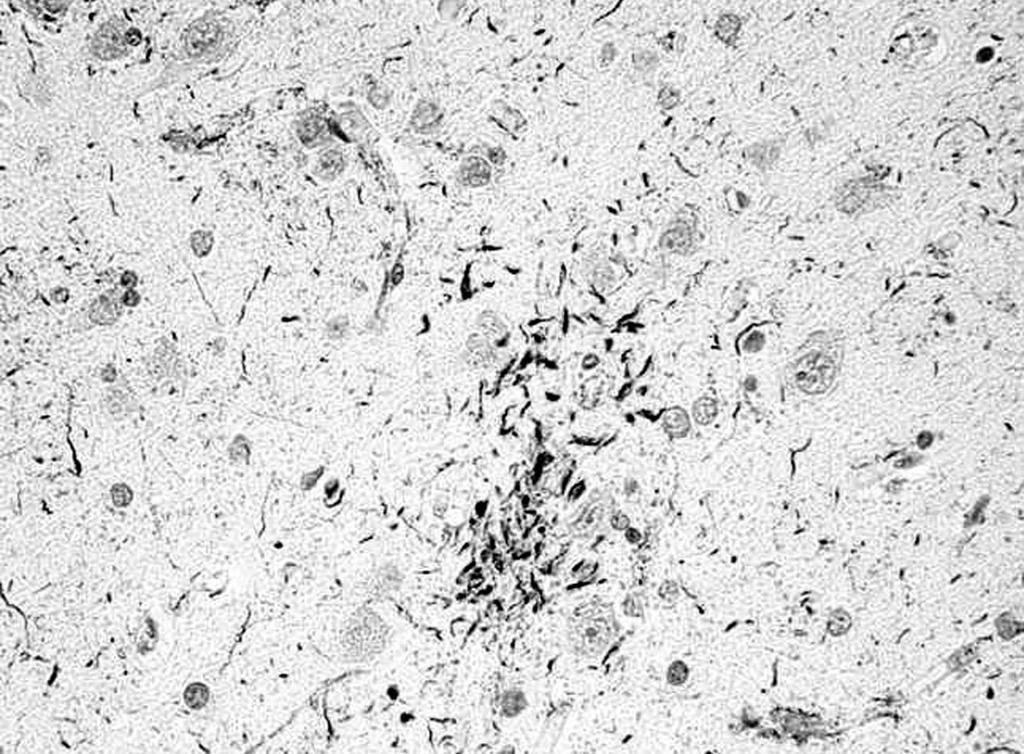 THE CANADIAN JOURNAL OF NEUROLOGICAL SCIENCES A B Figure 2: A) tau-immunopositive cortical glial plaque (AT8, original magnification X 200); B) Ballooned cortical neurons (H&E X 200).