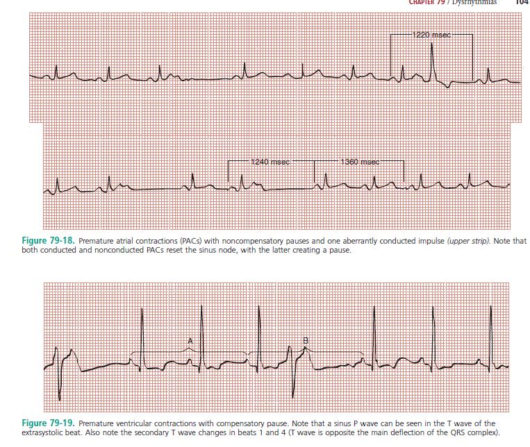 PAC's PVC's Abnormal P wave earlier in the cycle than it should appear Benign may herald myocardial irritability, catecholamine excess, ischemia, heart failure, hyperthyroidism, metabolic derangement
