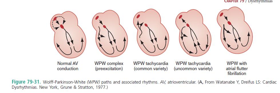 Wolff-Parkinson-White (WPW) syndrome is the classic accessory pathway syndrome, characterized by paroxysmal tachycardia and the following three resting ECG features. - Rosen s 7th Ed.