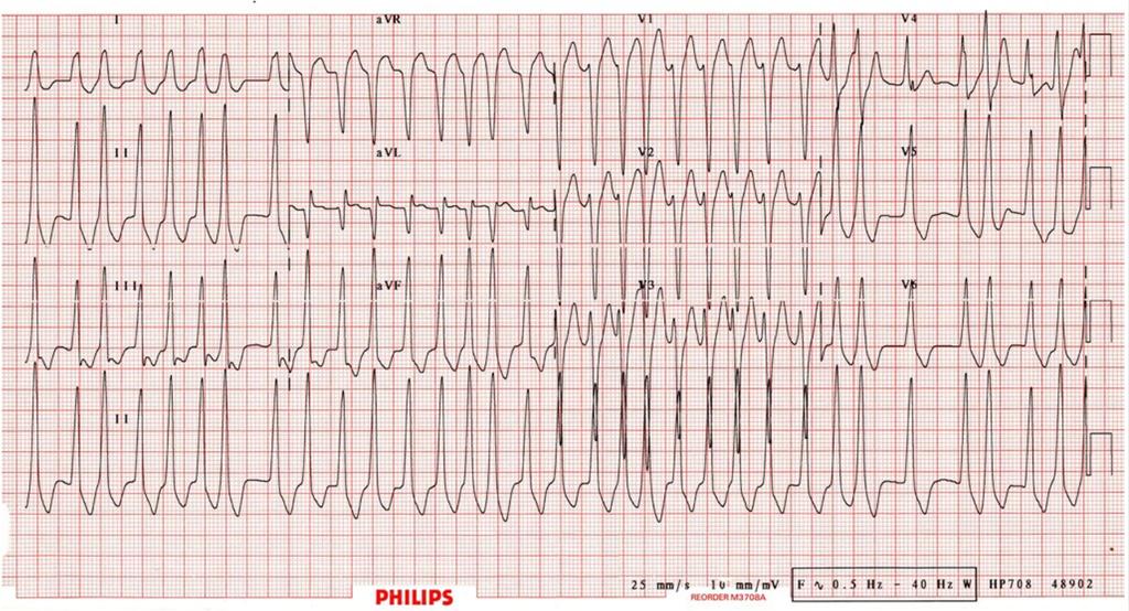 Crack Cast Show Notes Dysrhythmias May 2017 AV node used for anterograde conduction and the accessory pathway used for retrograde conduction. ****NARROW QRS**** is produced Presence of A fib.