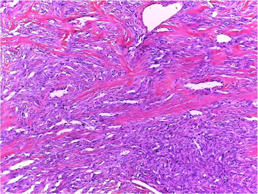 The patient has been followed-up for eleven months, with no signs of recurrence. Discussion SFT is an exceedingly rare neoplasm in the parotid gland.