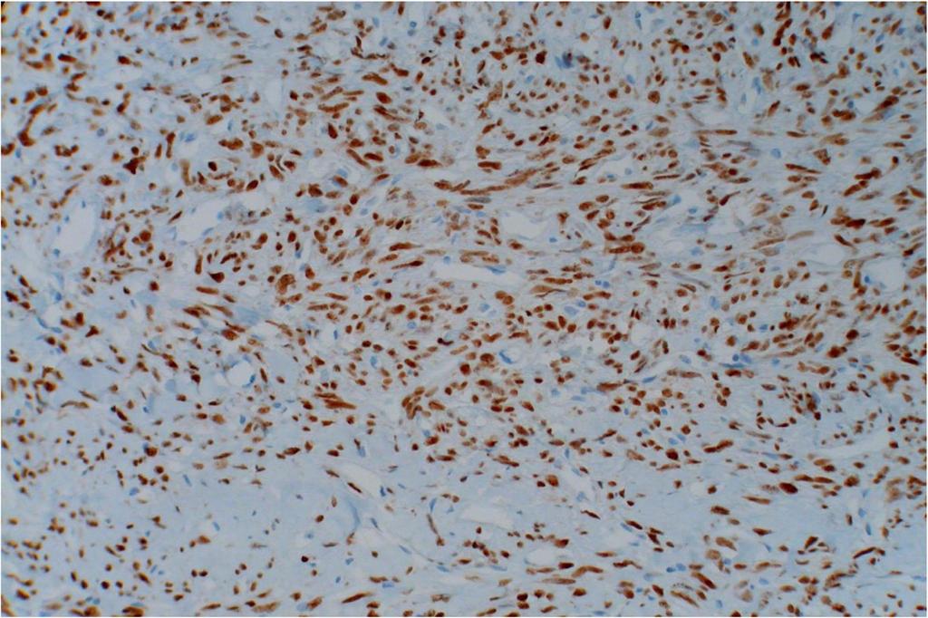 Rais et al. BMC Clinical Pathology (2017) 17:22 Page 4 of 5 Fig. 5 STAT6 immunostain showing diffuse staining of the tumor cells SFTs [14].