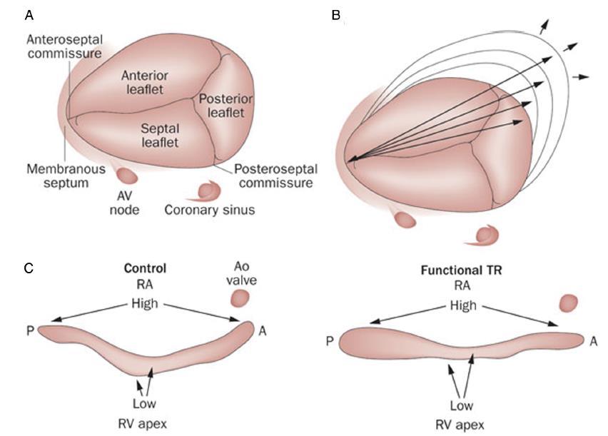 TR occurs as the result of the effect of increased RV afterload on RV dilatation and function.