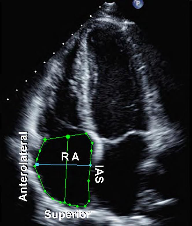 Right Atrium Evaluation Apical 4-chamber view End-systole Significant dilatation if > 18cm² Right atrial enlargement is a manifestation of high right