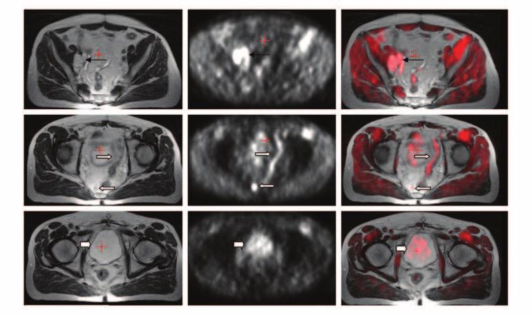 Radiotherapy of pelvic lymph nodes above the initial radiation field led to an undetectable serum prostate-specific antigen.