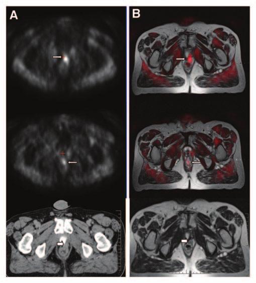 AC PET With CT/MRI Fusion in Prostate Cancer patients were excluded from local salvage radiotherapy and received palliative combined hormonal treatment and radiotherapy.