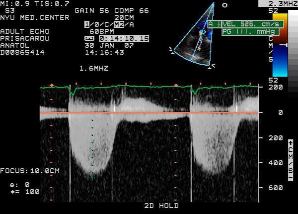 16) PVR=Wood s units TR Velocity = m/sec RVOT TVI = cm Conclusions Normal and abnormal hemodynamics can be evaluated non