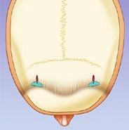 With one third the mass of an ENDOTINE Forehead, the Forehead-mini will more quickly absorb to an impalpable