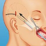 2 PLACEMENT Insert the Midface device through the temporal incision to the desired