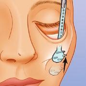 infraorbital incision and advance it to the desired