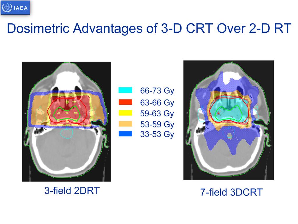 Multiple field planning with 3D CRT yields a better dose distribution around the target volume.