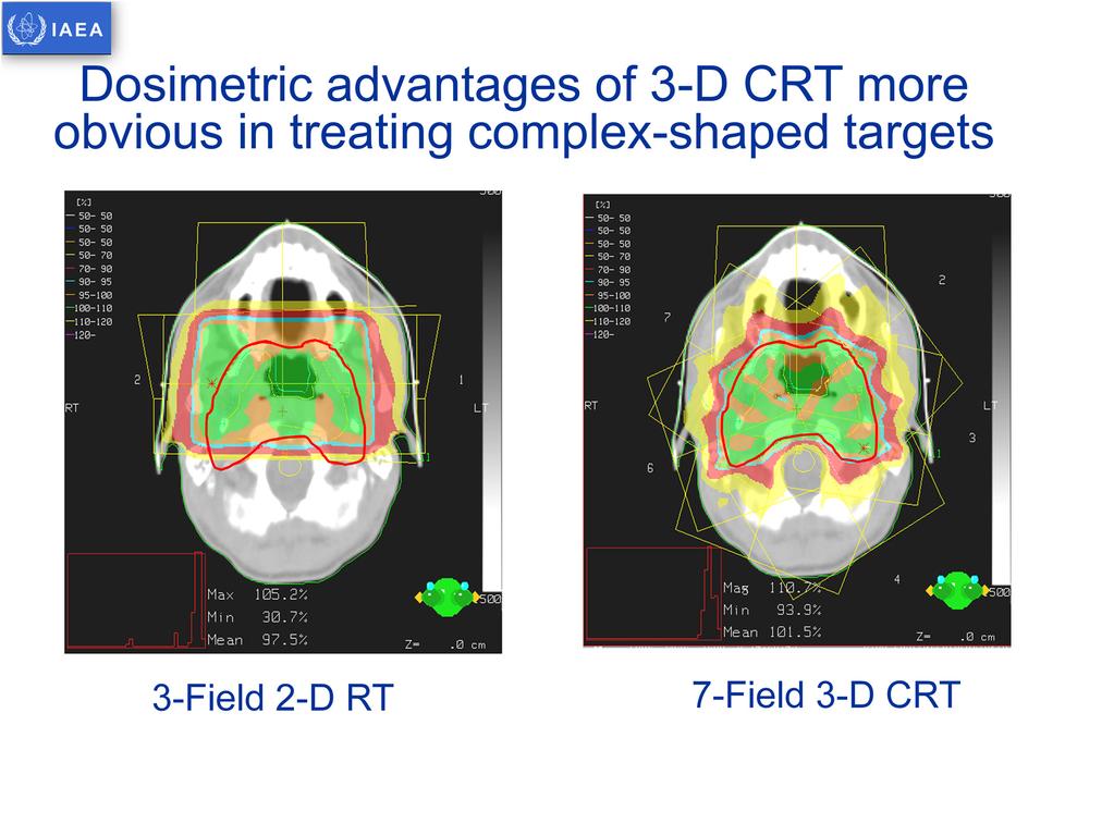 The advantage of 3D CRT and multiple beam plans is even more obvious with complex shaped target.