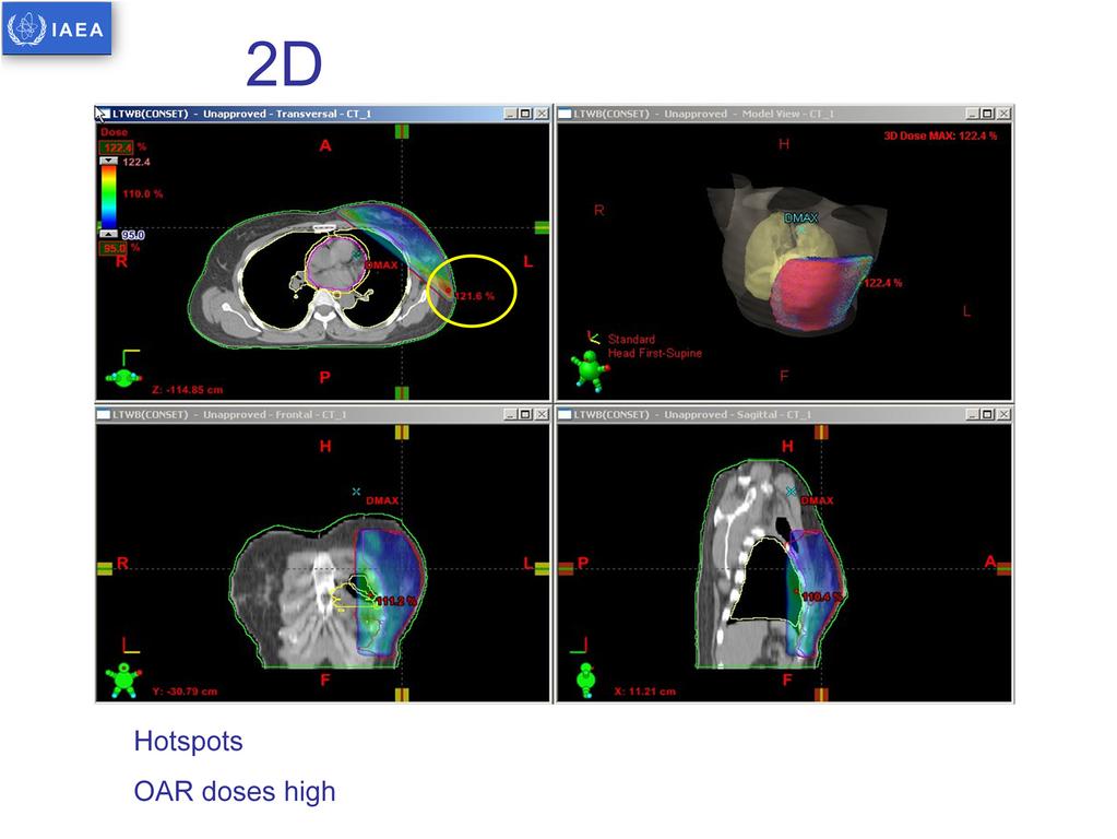 In 2D planning, the dose at the central slice may be adequate but we can see there are