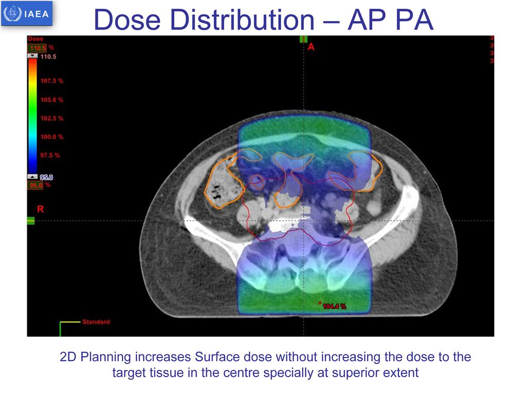 Simple AP/PA fields results in increased doses to the surface and subcutaneous tissue.