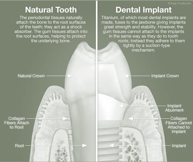 DENTAL IMPLANTS NOW Dental Implants Now Over the last two decades dental implants have transformed tooth replacement treatments and the practice of dentistry.